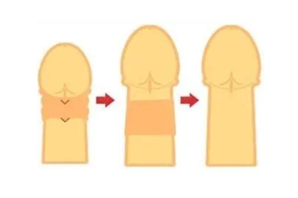 程开祥医生做手术贵不贵？