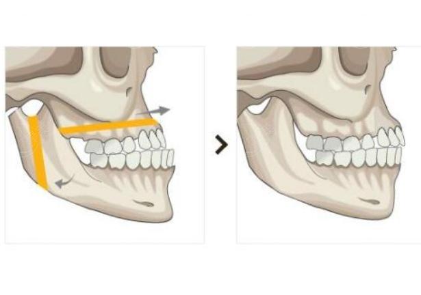 肖林医生做下颌角正颌有名