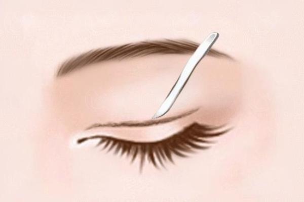 连云港双眼皮割眼睑推荐医院分析