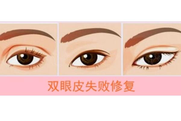 连云港双眼皮割眼睑推荐医院分析
