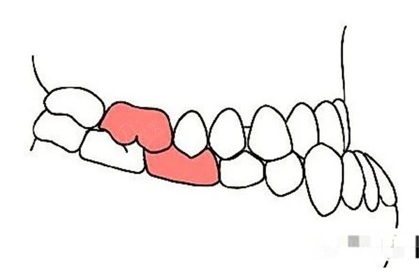 2025地包天矫正价格表更新:地包天矫正费用大概多少钱一文了解