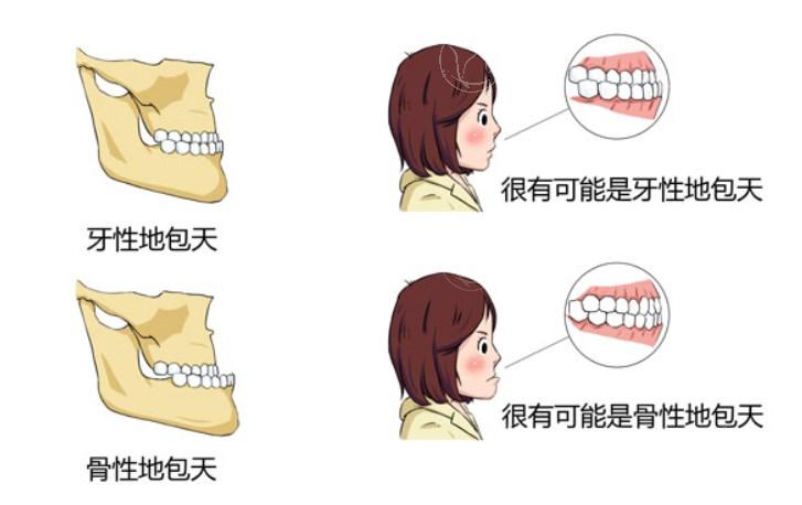 2025地包天矫正价格表更新:地包天矫正费用大概多少钱一文了解