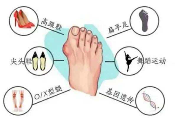 苏敬达做大脚骨手术技术水平咋样？从多年手术实例来看名不虚传