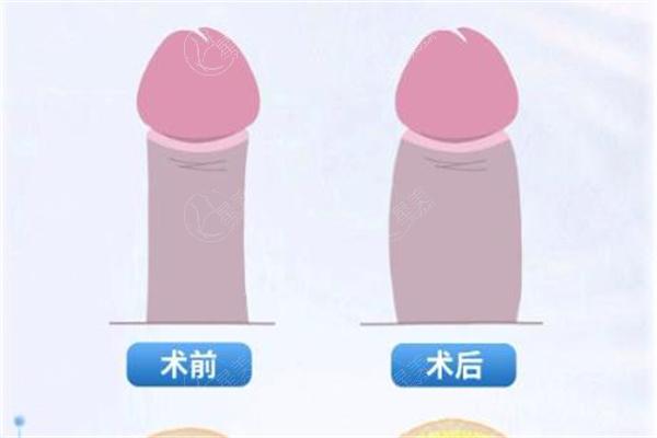 程开祥医生增粗价格3w起:程开祥是正规医生做增粗术后直径能增加1cm+
