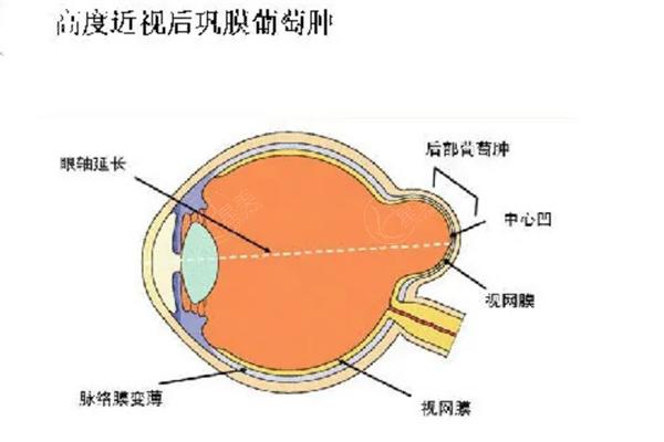 国内做后巩膜加固术好的医生排名榜