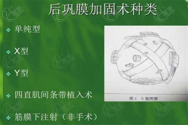 国内做后巩膜加固术好的医生排名榜