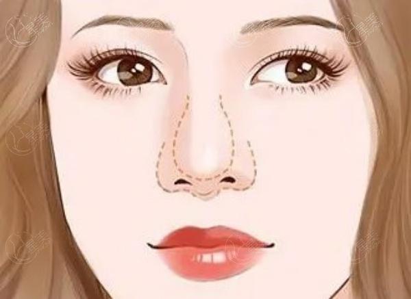 3d隆鼻1.jpg
