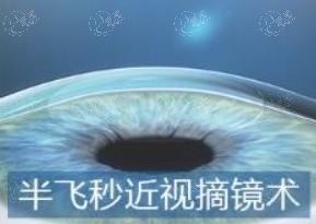 成都蔡司精雕飞秒A+排名前10名单 这些都是成都正规且规模大的机构喔