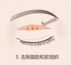 揭晓合肥整形医院吸脂塑形整形要多少钱 其中瘦大腿价格29800起、溶脂瘦腰腹价格8800起