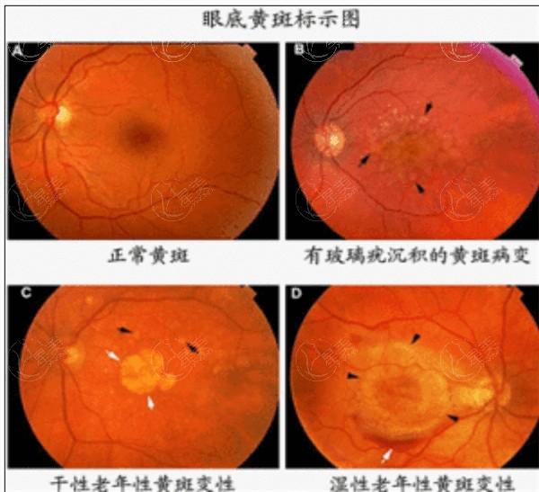 杭州连续视程晶体9大排名榜 杭州茗视佳眼科医院技术靠谱性价比高