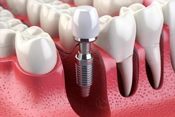 来看看合肥牙科的医院补牙价目表 网友直呼瓷化树脂充填100元+龋齿100元起元+太实惠