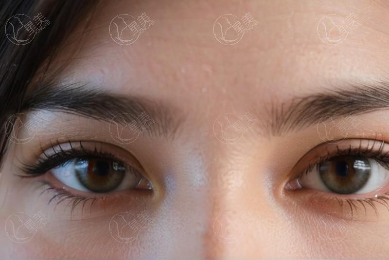 桂林赋盈眼科白内障手术收费标准？发现收费合理且有优惠