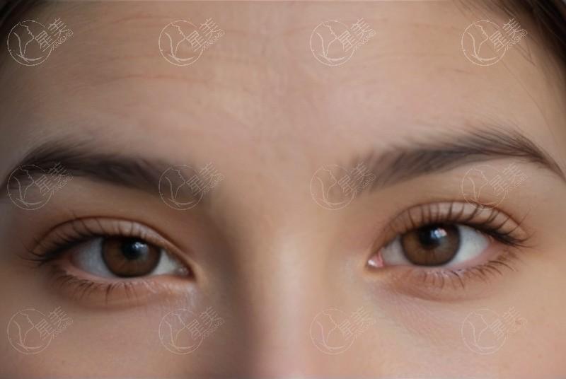 镇江华厦眼科眼科技术项目收费：激光近视手术10700+人工晶体植入27300+斜视矫正4400+